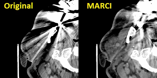 Metal artefact reduction by MARCI